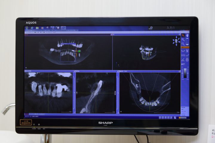 歯科用CTによる正確な診断
